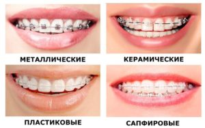 metallicheskie_breketi-3